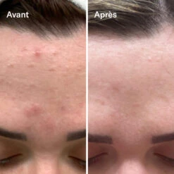 Bl+C Serum Concentré Anti-Imperfections Cumin Noir + Cajeput -OH MY CREAM! 202407 Odacite BI CSerumConcentreAntiImperfections AvantApres2