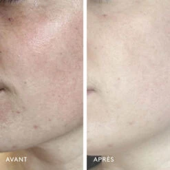 Milky Way Sérum Exfoliant 10% Acide Lactique 6 Milky Way Sérum Exfoliant 10% Acide Lactique -OH MY CREAM! Avant apres MilkyWayHerbivore2