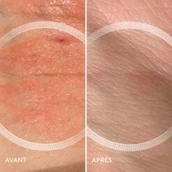 Lyma Laser -OH MY CREAM! avant apres lyma