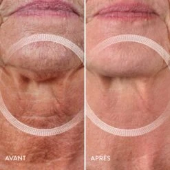 Lyma Laser -OH MY CREAM! avant apres lyma2