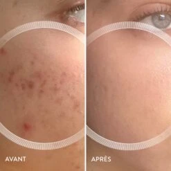 Lyma Laser -OH MY CREAM! avant apres lyma3